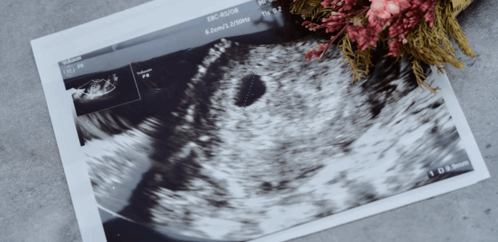 エコー写真が色褪せて消える原因と保存方法の基本知識